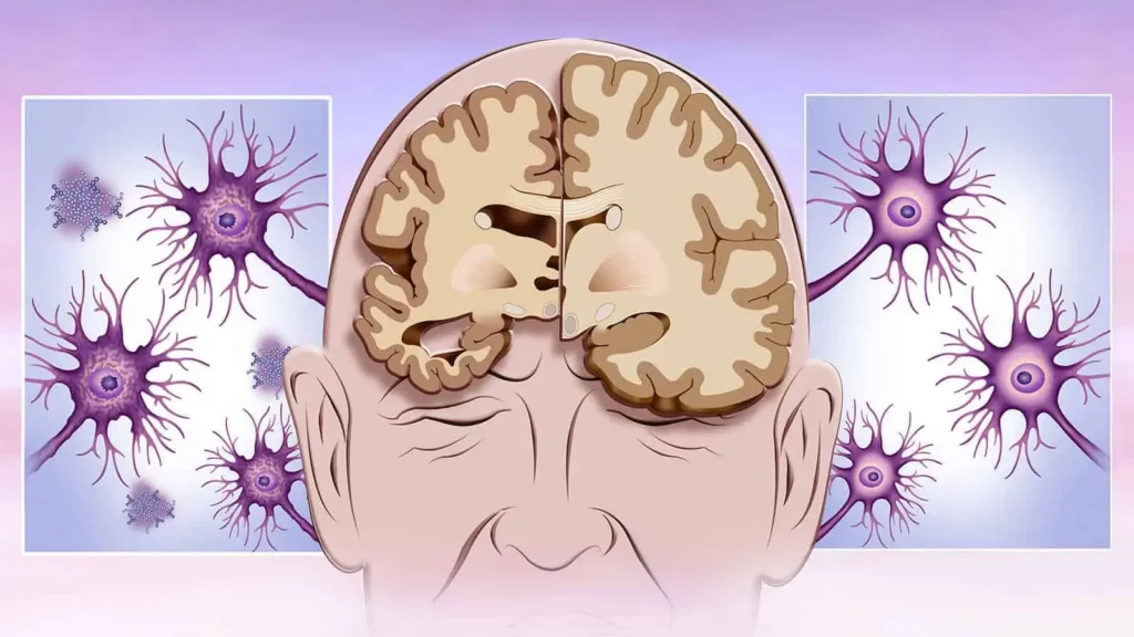 Alluminio e patologia di Alzheimer: esiste una correlazione?